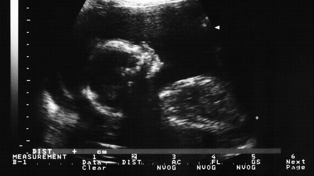 Image of baby ultrasound